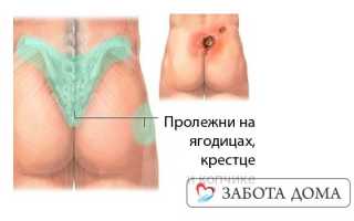 Пролежень на копчике до кости