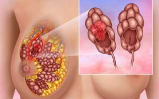 Протоковая карцинома — все о болезни