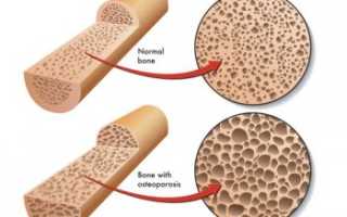 Все о остеопорозе костей