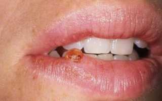 Все о саркоидозе