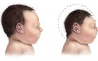 Все о микроцефалии