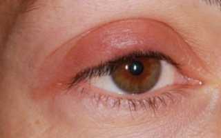 Почему отекают верхние веки?