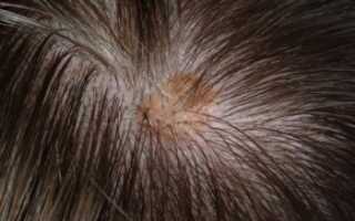 Себорейный дерматит