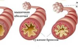Астматический статус