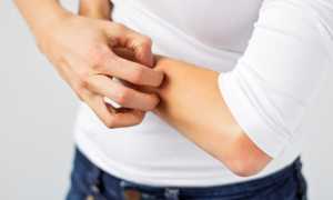 Все об экземе