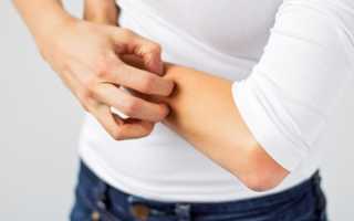 Все об экземе