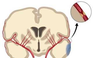 Ишемический инсульт