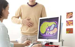 Цирроз печени