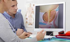 Карцинома простаты — симптоматика и тактика лечения