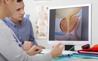 Карцинома простаты — симптоматика и тактика лечения