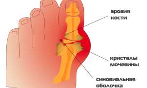 Как использовать Димексид при подагре?