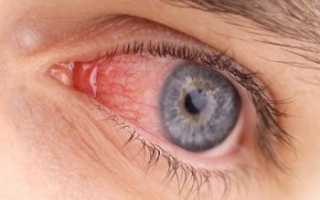 Лечение конъюнктивита дома