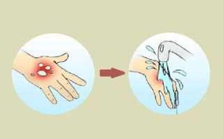 Первая помощь при радиационных ожогах