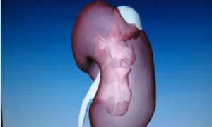 Аденома надпочечника