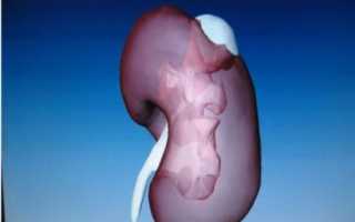 Аденома надпочечника