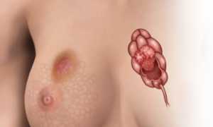 Карцинома груди — прогноз и методы лечения