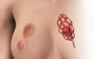 Карцинома груди — прогноз и методы лечения