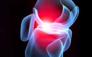 Все о остеоартрозе