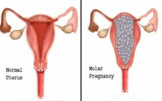 Все о пузырном заносе