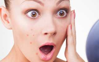 Как принимать Метронидазол от прыщей?