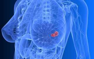 Все о фиброаденоме молочной железы