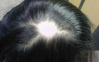 Все о гнездной алопеции