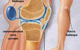 Почему болит колено с внутренней стороны?