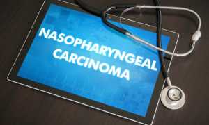 Все о назофарингеальной карциноме