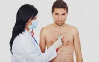 Пути передачи ветряной оспы