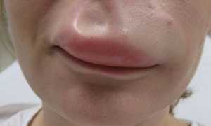 Отек Квинке — опасное состояние