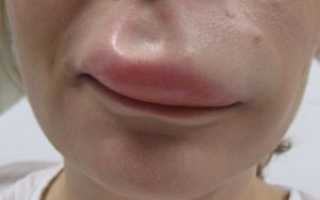 Отек Квинке — опасное состояние