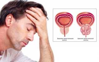 Аденома предстательной железы