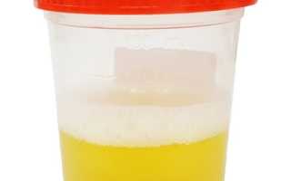 Протеинурия