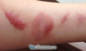 Чтобы не было рубцов после ожога лечение