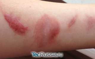 Чтобы не было рубцов после ожога лечение