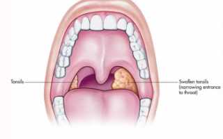 Хронический тонзиллит