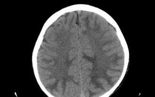 Энцефалопатия резидуальная