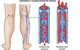 Как принимать Аспирин при тромбозе?