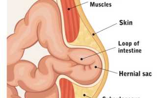 Все о грыжах