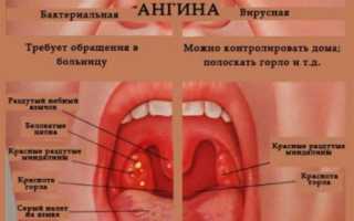 Как вылечить ангину при грудном вскармливании?
