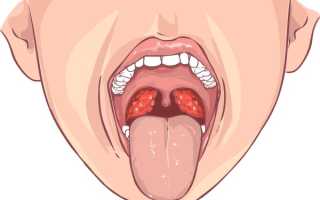 Поможет ли Настойка Прополиса от фарингита?