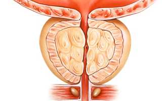 Как лечить аденому простаты у мужчин?