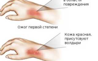 Первая помощь при ожоге 2 степени что делать
