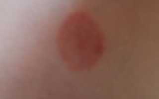 Пятна похожие на ожог на теле фото и описание