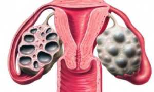 Поликистоз яичников