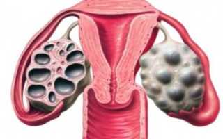 Поликистоз яичников