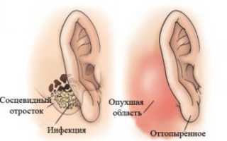 Все о мастоидите