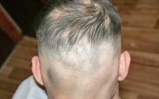 Подробно об алопеции у детей