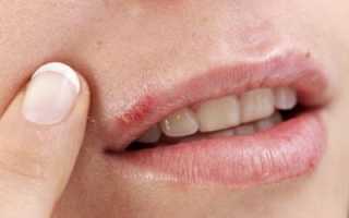 Мази от герпеса на губах