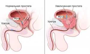 Признаки аденомы простаты